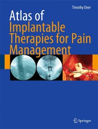 Cover Atlas of Implantable Therapies for Pain Management