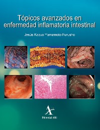 Cover Tópicos avanzados en enfermedad inflamatoria intestinal