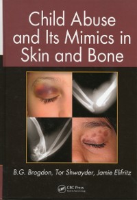 Cover Child Abuse and its Mimics in Skin and Bone