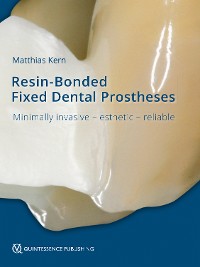 Cover Resin-Bonded Fixed Dental Prostheses