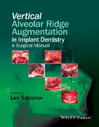 Cover Vertical Alveolar Ridge Augmentation in Implant Dentistry