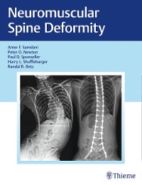 Cover Neuromuscular Spine Deformity