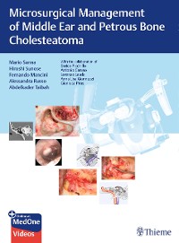 Cover Microsurgical Management of Middle Ear and Petrous Bone Cholesteatoma