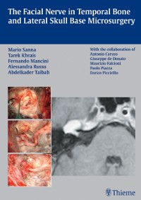 Cover Facial Nerve in Temporal Bone and Lateral Skull Base Microsurgery