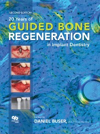 Cover 20 Years of Guided Bone Regeneration in Implant Dentistry