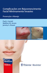Cover Complicações em Rejuvenescimento Facial Minimamente Invasivo
