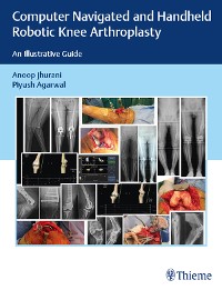 Cover Computer Navigated and Handheld Robotic Knee Arthroplasty