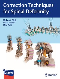 Cover Correction Techniques for Spinal Deformity