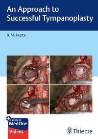 Cover An Approach to Successful Tympanoplasty