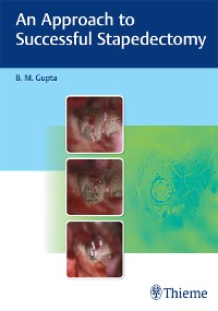 Cover An Approach to Successful Stapedectomy