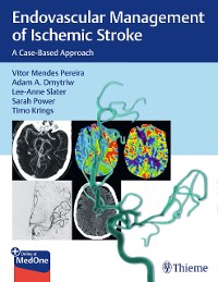 Cover Endovascular Management of Ischemic Stroke