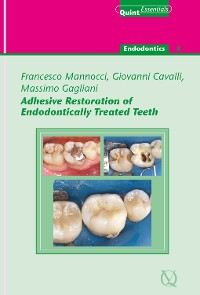 Cover Adhesive Restoration of Endodontically Treated Teeth