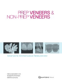 Cover Prep Veneers und Non-Prep Veneers