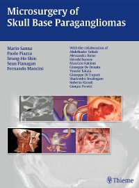 Cover Microsurgery of Skull Base Paragangliomas