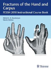 Cover Fractures of the Hand and Carpus