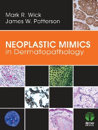 Cover Neoplastic Mimics in Dermatopathology