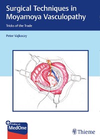 Cover Surgical Techniques in Moyamoya Vasculopathy