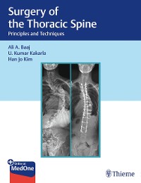 Cover Surgery of the Thoracic Spine
