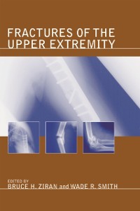 Cover Fractures of the Upper Extremity