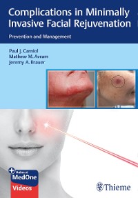 Cover Complications in Minimally Invasive Facial Rejuvenation