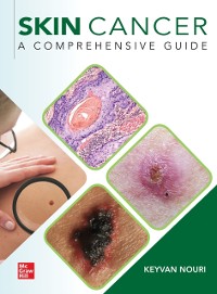 Cover Skin Cancer: A Comprehensive Guide