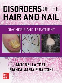 Cover Disorders of the Hair and Nail: Diagnosis and Treatment