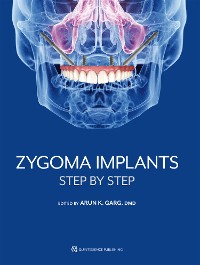 Cover Zygoma Implants
