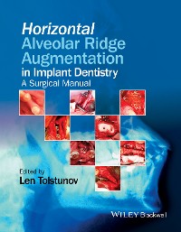 Cover Horizontal Alveolar Ridge Augmentation in Implant Dentistry