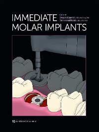 Cover Immediate Molar Implants