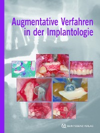 Cover Augmentative Verfahren in der Implantologie