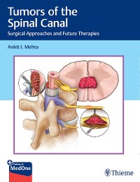 Cover Tumors of the Spinal Canal