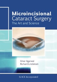 Cover Microincisional Cataract Surgery