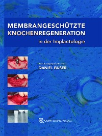 Cover Membrangeschützte Knochenregeneration in der Implantologie